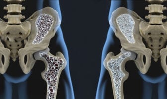 lancamento-da-libbs-para-osteoporose-reduz-incidencia-de-novas-fraturas