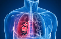 câncer-pulmão