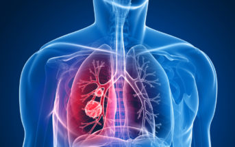 câncer-pulmão