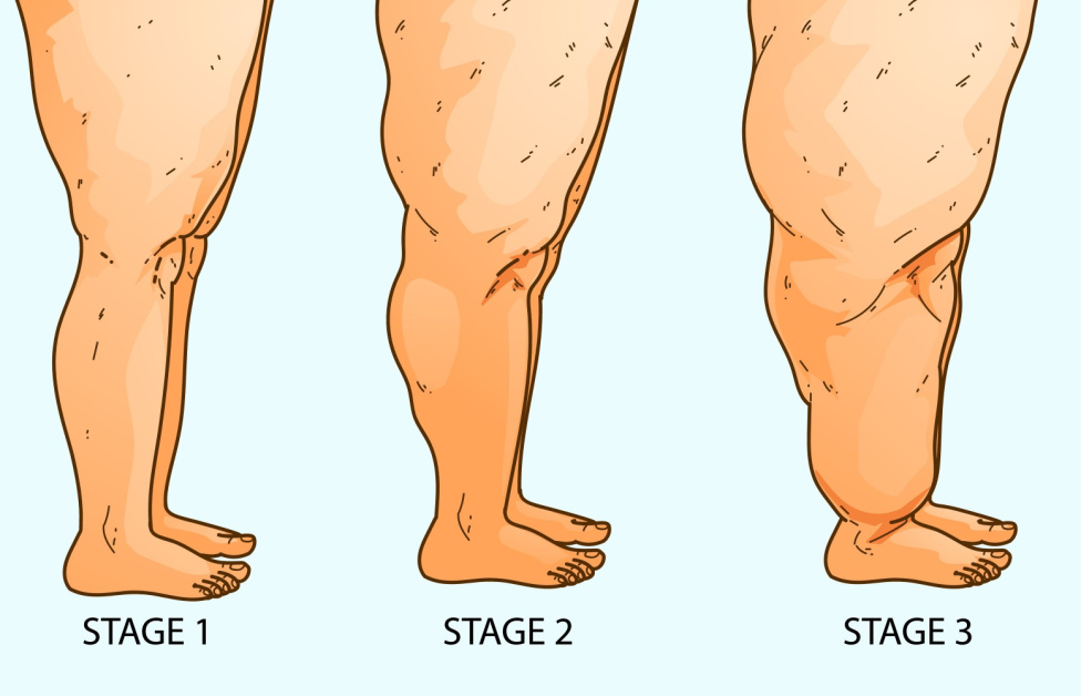 Gordura nas pernas e quadris? Médico explica o que é Lipedema