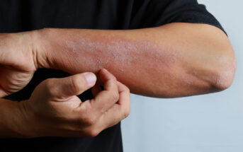 dermatite-atopica-lesoes-e-coceira-que-colocam-a-pele-em-risco