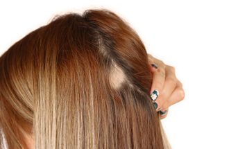 alopecia-areata-que-provoca-falhas-circulares-sem-pelos-esta-em-alta-apos-covid-sugere-estudo