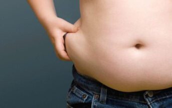 sobrepeso-pode-causar-e-piorar-varizes-e-trombose